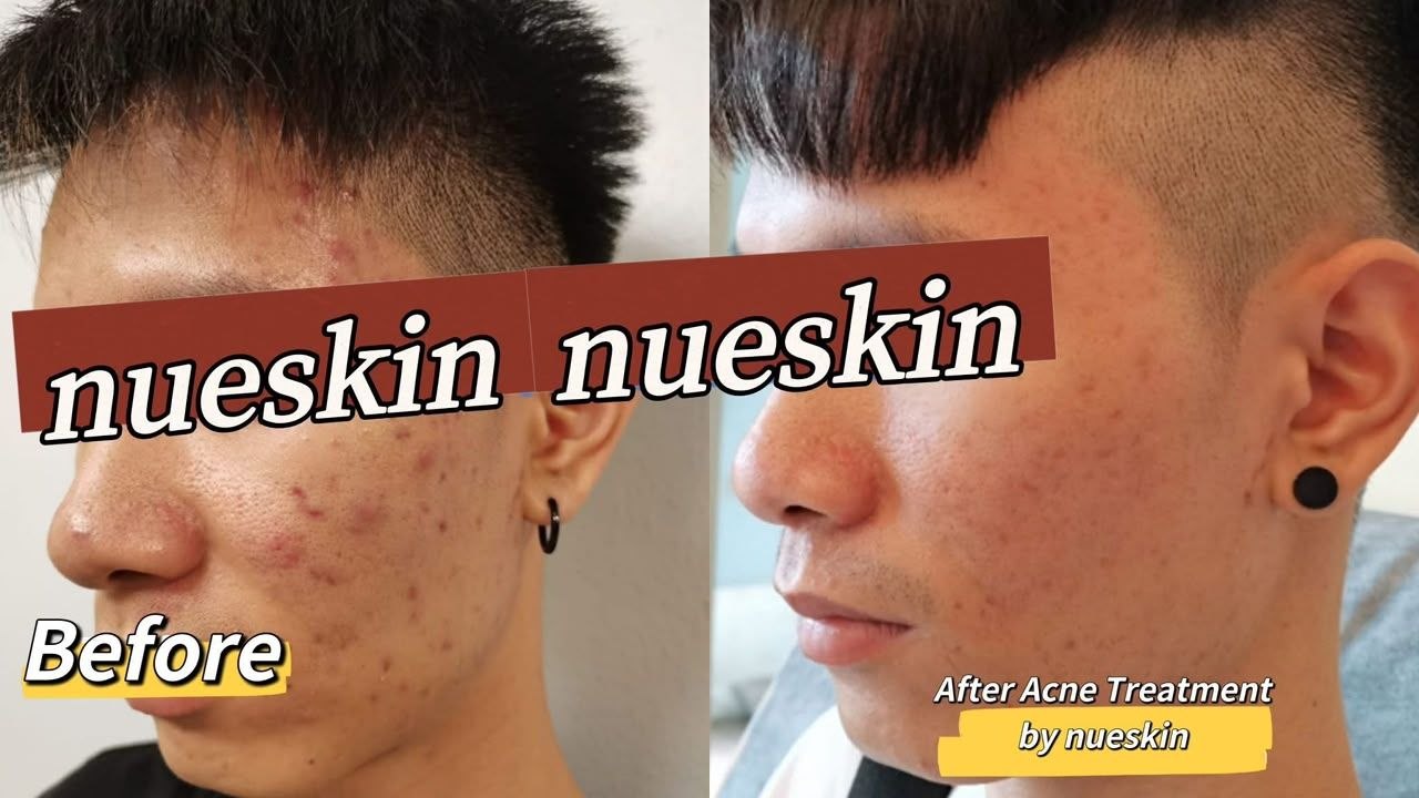 Acne Treatment before and after — Nue Skin Beauty Esthetique