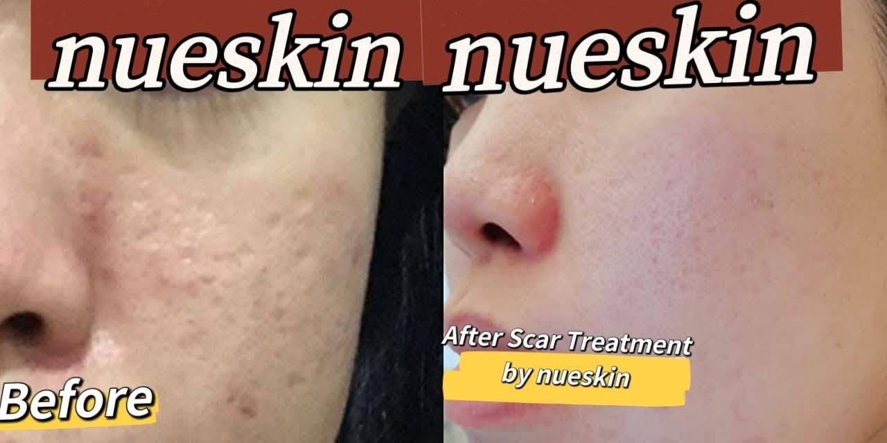 Acne Treatment before and after — Nue Skin Beauty Esthetique