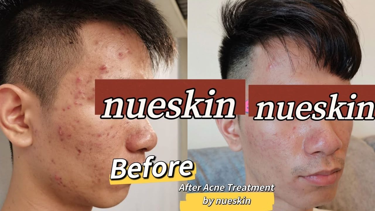 Acne Treatment before and after — Nue Skin Beauty Esthetique
