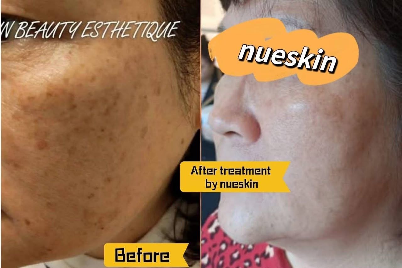 Acne Treatment before and after — Nue Skin Beauty Esthetique