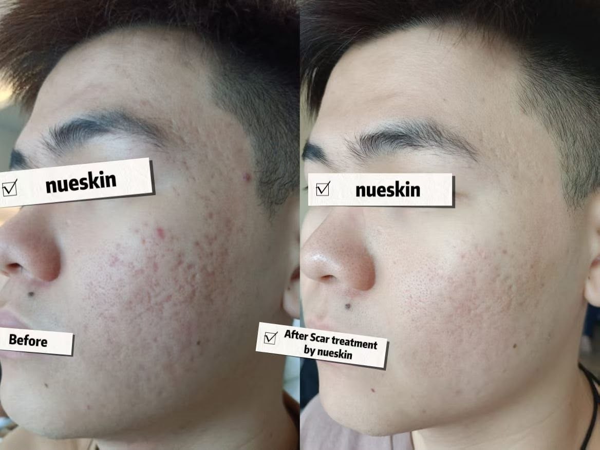 Acne Treatment before and after — Nue Skin Beauty Esthetique