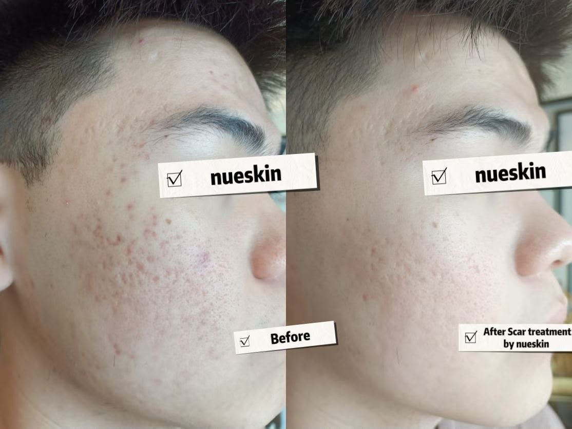 Acne Treatment before and after — Nue Skin Beauty Esthetique