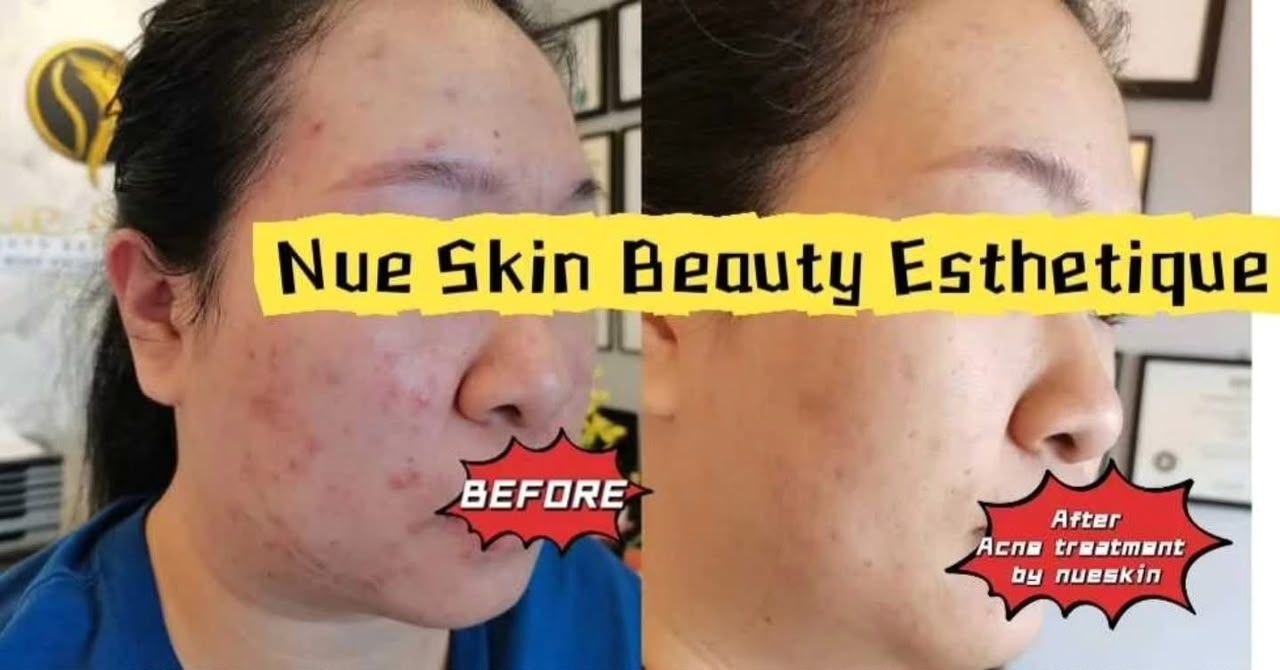 Acne Treatment before and after — Nue Skin Beauty Esthetique