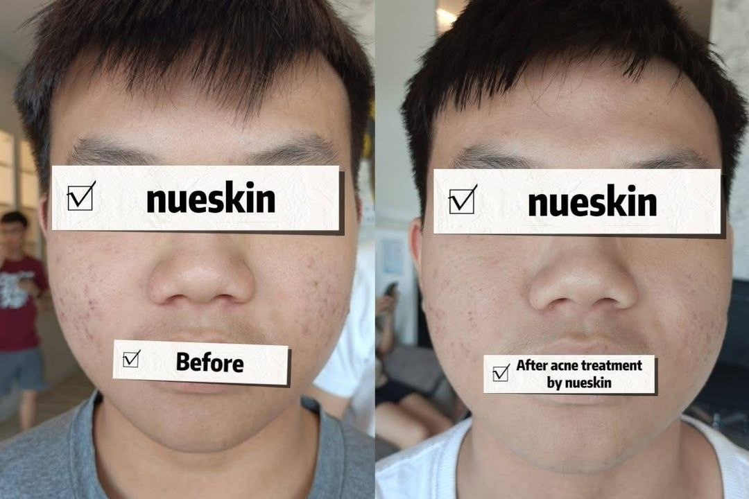 Acne Treatment before and after — Nue Skin Beauty Esthetique