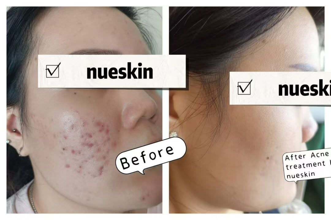 Acne Treatment before and after — Nue Skin Beauty Esthetique