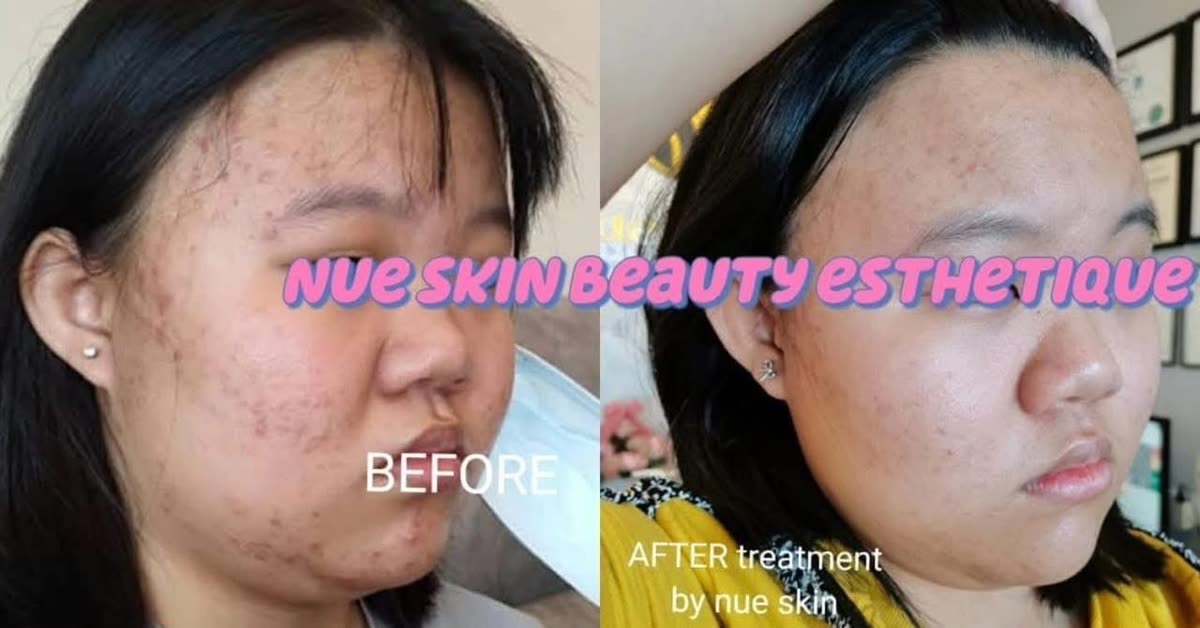 Acne and acne-scar treatment on cheek before and after — Nue Skin Beauty Esthetique