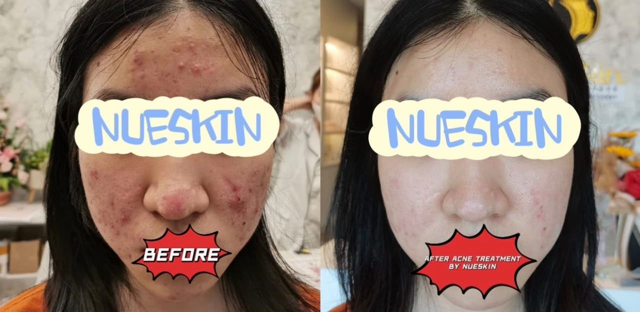 Acne breakout treatment on cheeks before and after — Nue Skin Beauty Esthetique