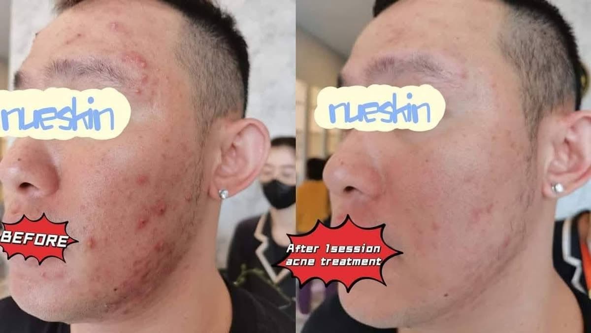 Acne treatment on cheek and jaw before and after one session — Nue Skin Beauty Esthetique