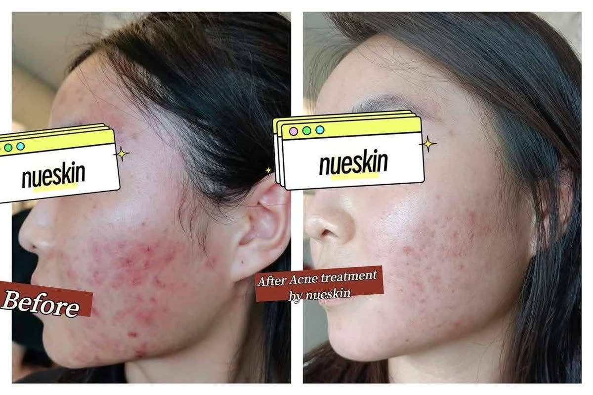 Acne treatment cheek before and after — Nue Skin Beauty Esthetique