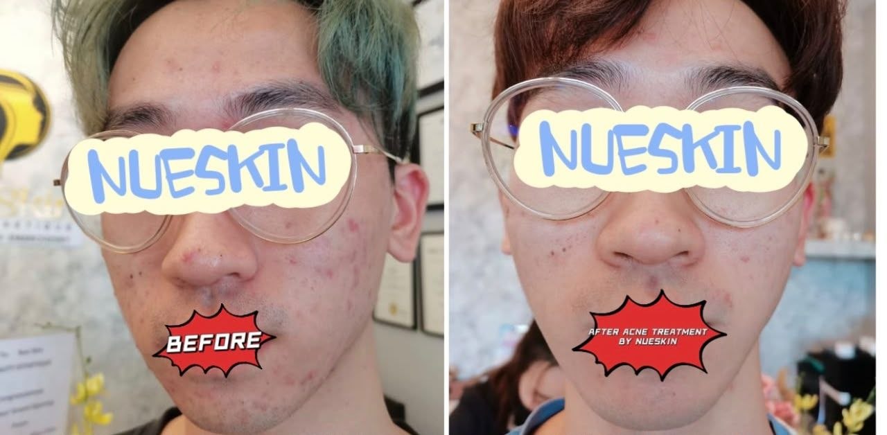 Facial acne and blemish treatment before and after — Nue Skin Beauty Esthetique