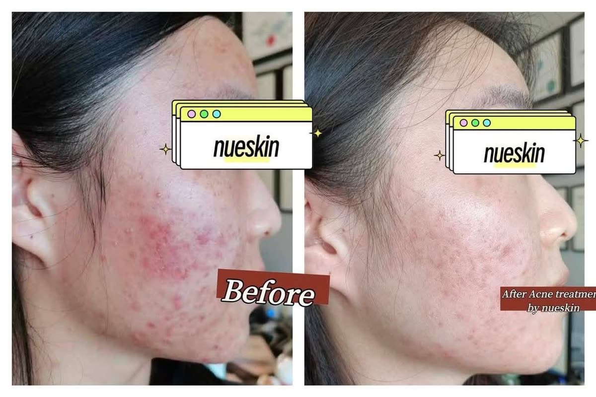Acne treatment full face results before and after — Nue Skin Beauty Esthetique