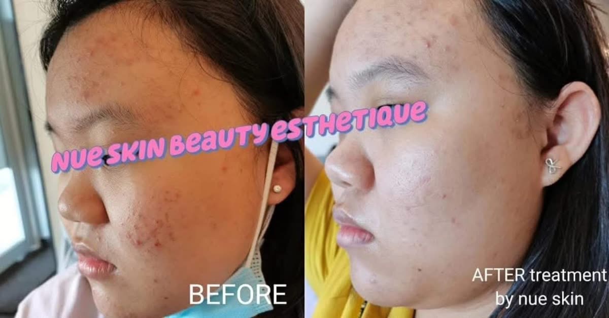 Acne treatment on cheek and jaw before and after — Nue Skin Beauty Esthetique