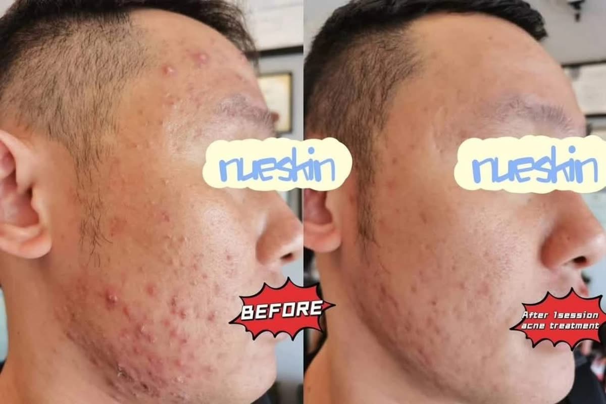 Acne treatment on jaw and cheek before and after one session — Nue Skin Beauty Esthetique