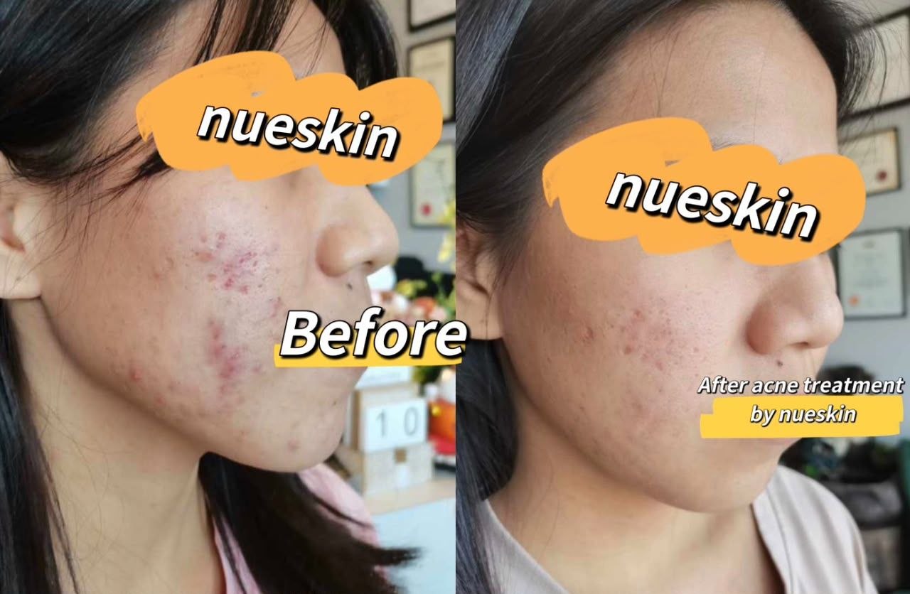 Acne breakout treatment on cheek side profile before and after — Nue Skin Beauty Esthetique