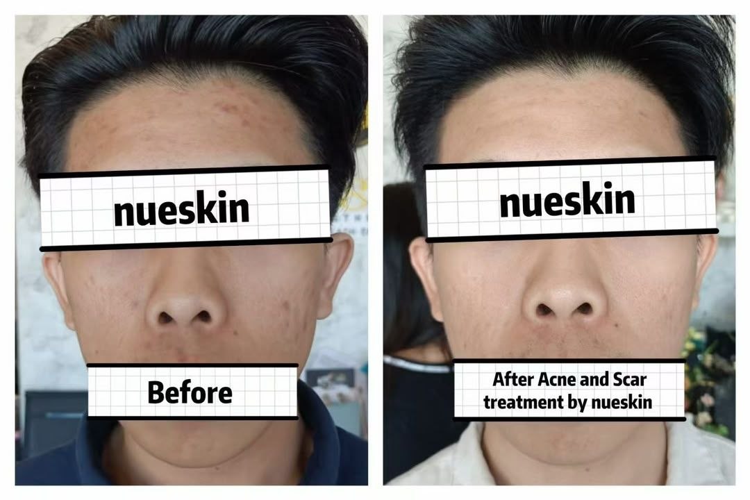 Scar Treatment before and after — Nue Skin Beauty Esthetique