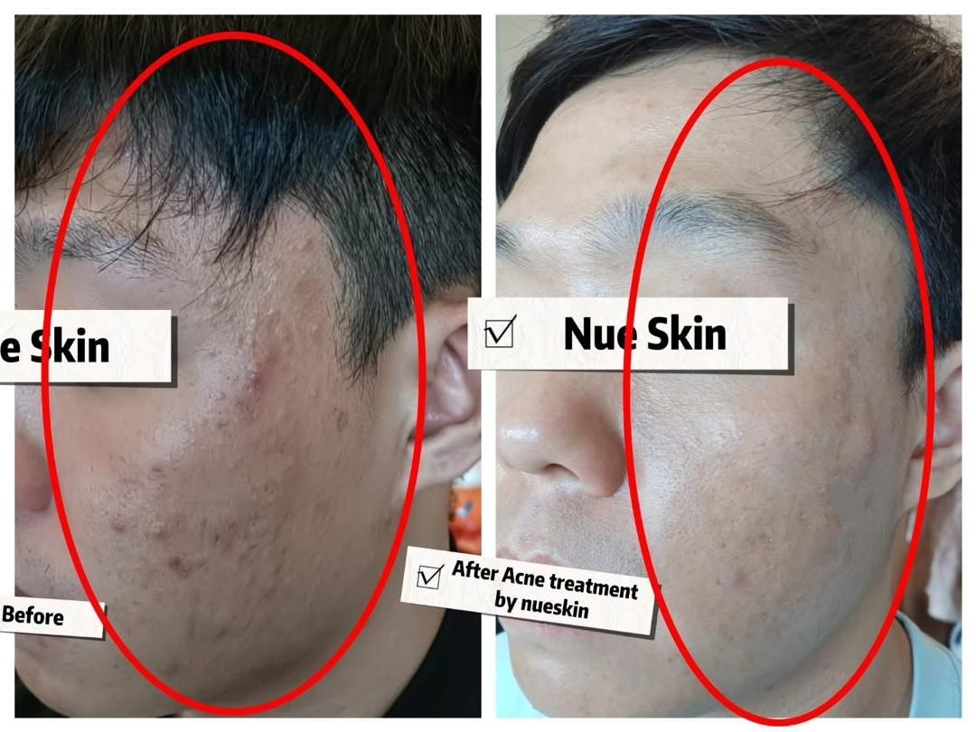 Scar Treatment before and after — Nue Skin Beauty Esthetique