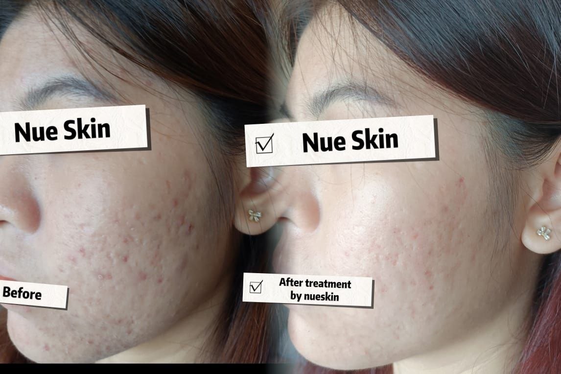 Acne and skin texture refinement before and after — Nue Skin Beauty Esthetique