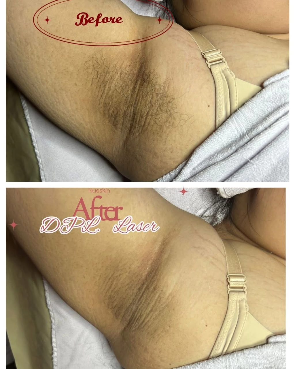 DPL Laser Hair Reduction before and after — Nue Skin Beauty Esthetique