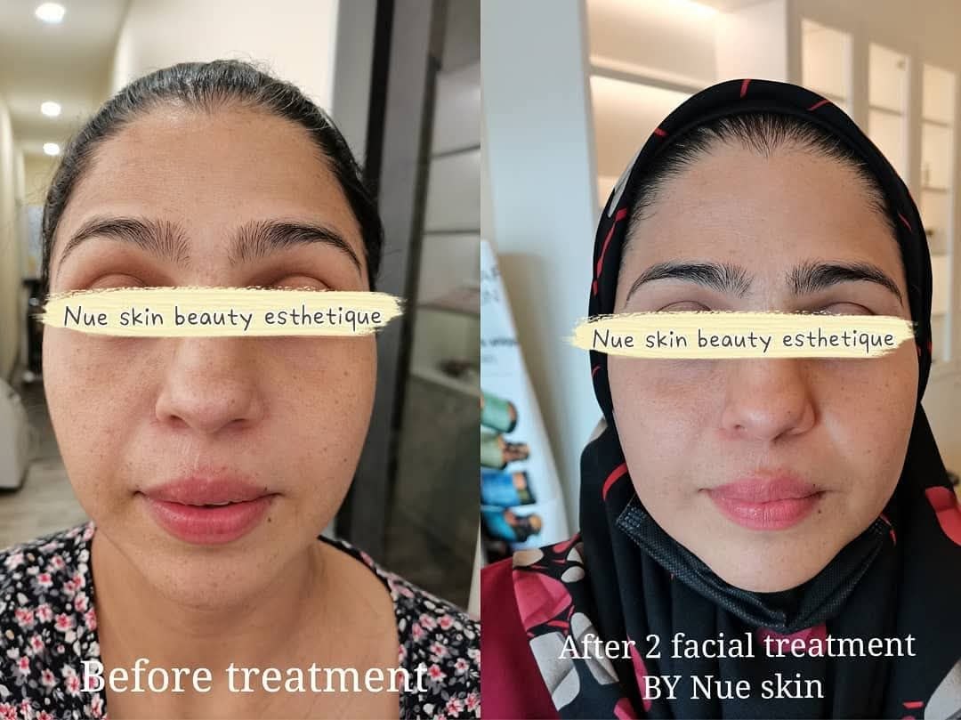 Facial Rejuvenation before and after — Nue Skin Beauty Esthetique