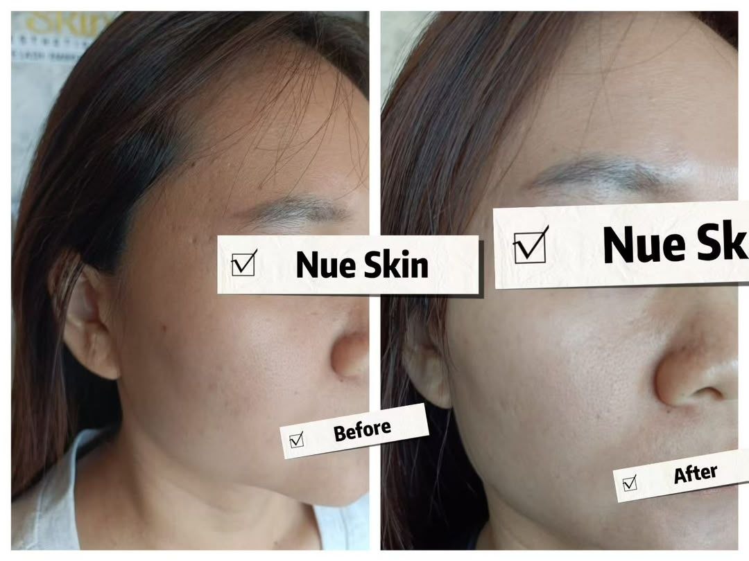 Facial Rejuvenation before and after — Nue Skin Beauty Esthetique