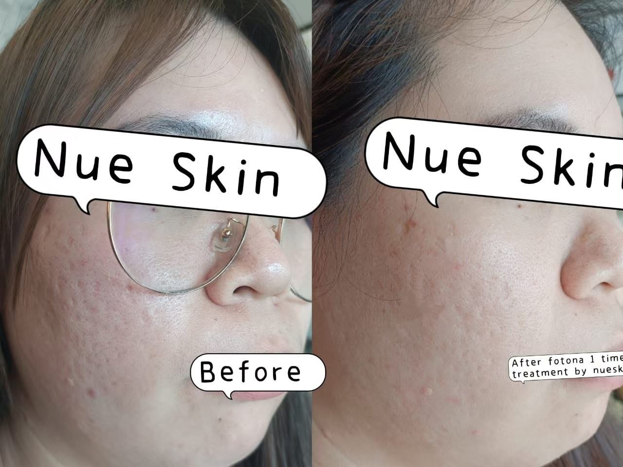 Facial Rejuvenation before and after — Nue Skin Beauty Esthetique