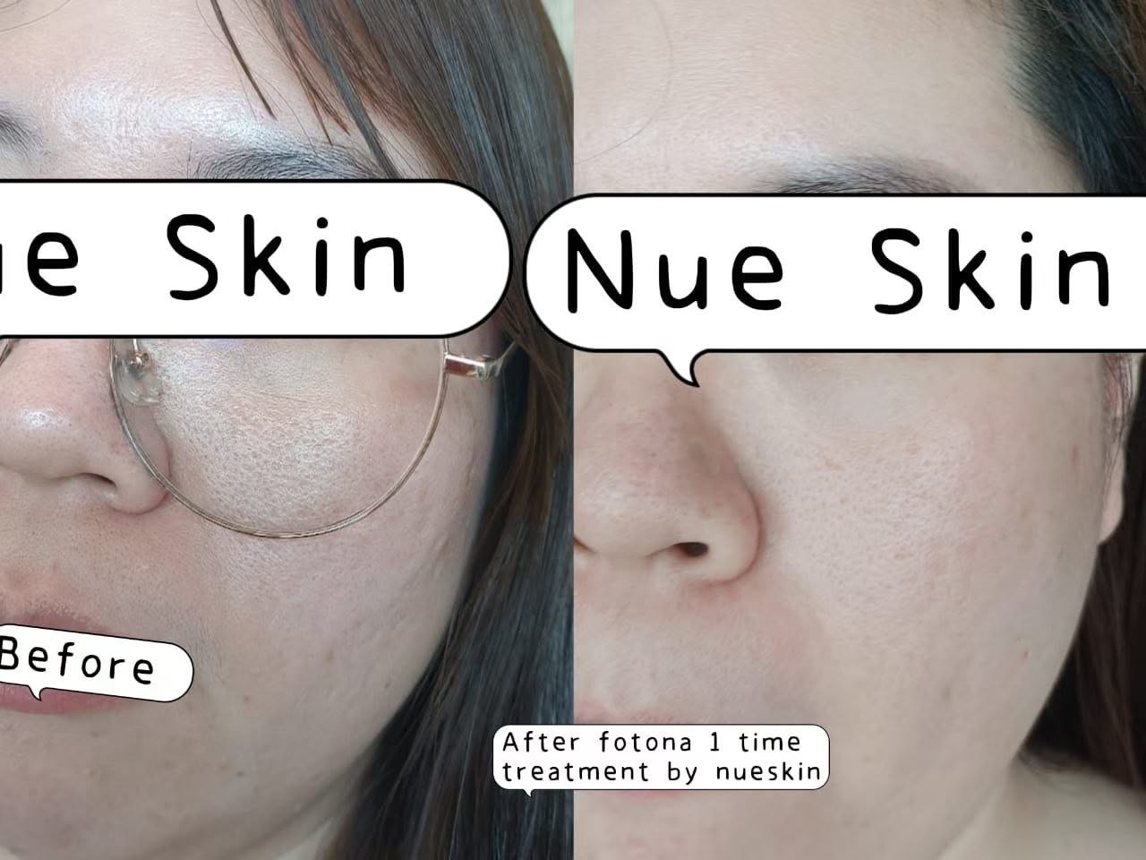 Facial Rejuvenation before and after — Nue Skin Beauty Esthetique