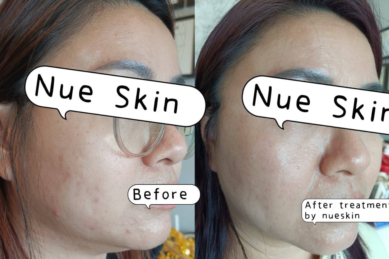 Facial Rejuvenation before and after — Nue Skin Beauty Esthetique