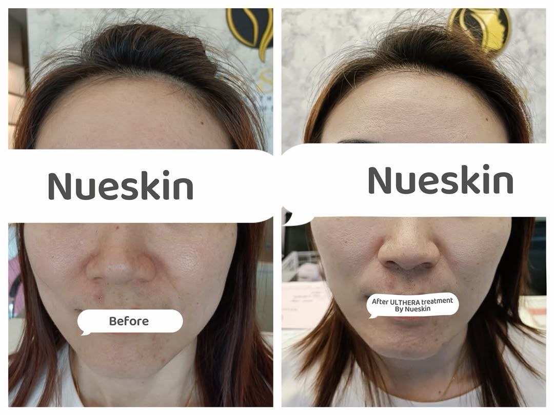 Face Contouring before and after — Nue Skin Beauty Esthetique