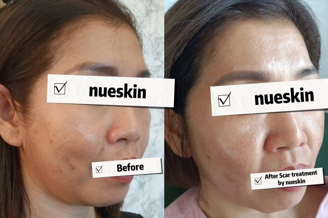 Scar Treatment before and after — Nue Skin Beauty Esthetique
