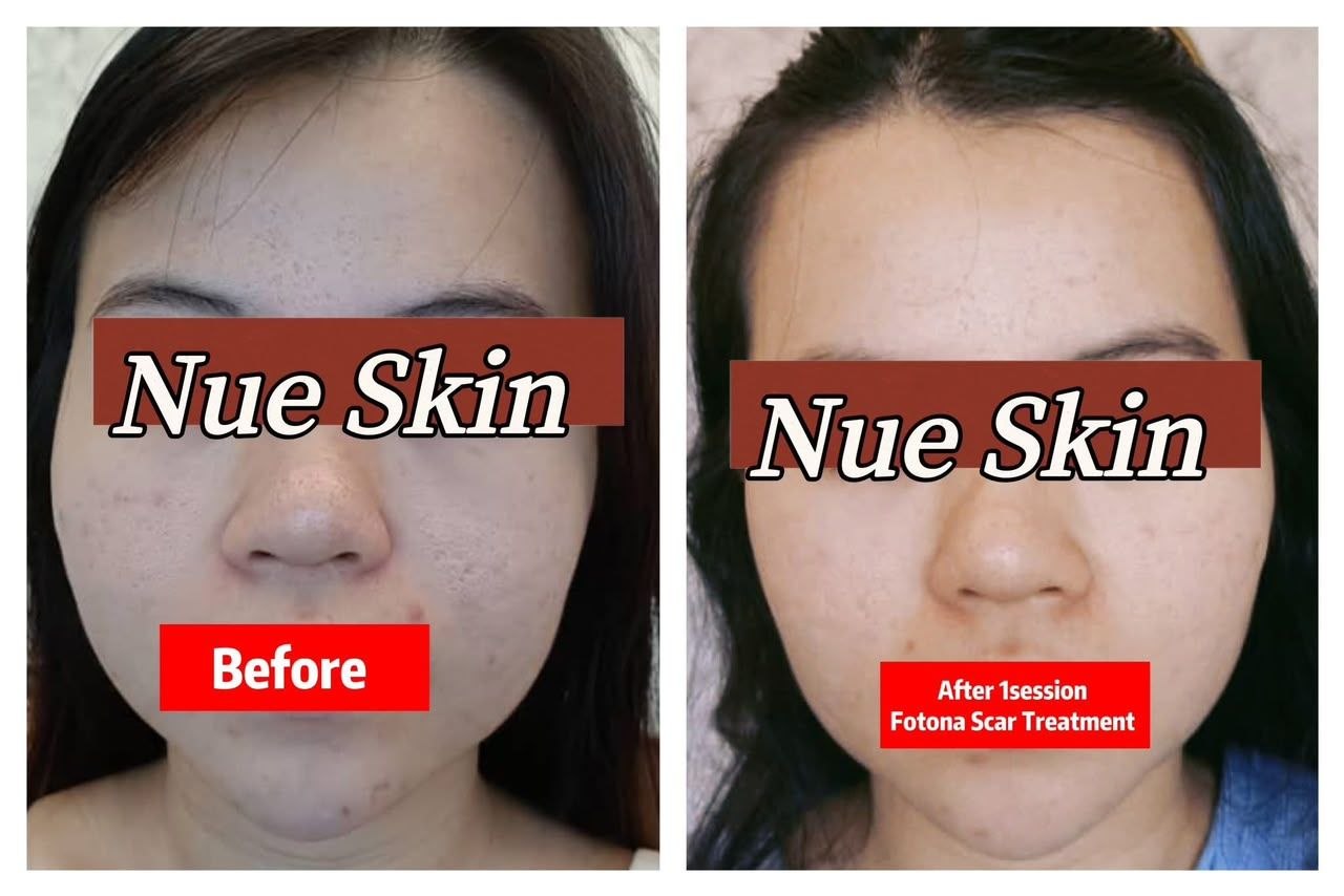 Fotona Scar Treatment before and after — Nue Skin Beauty Esthetique