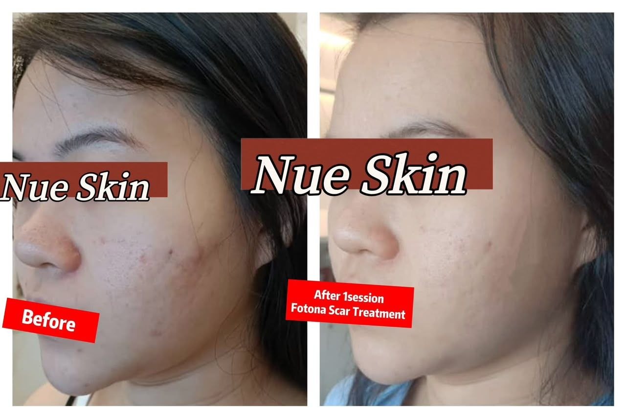 Fotona Scar Treatment before and after — Nue Skin Beauty Esthetique