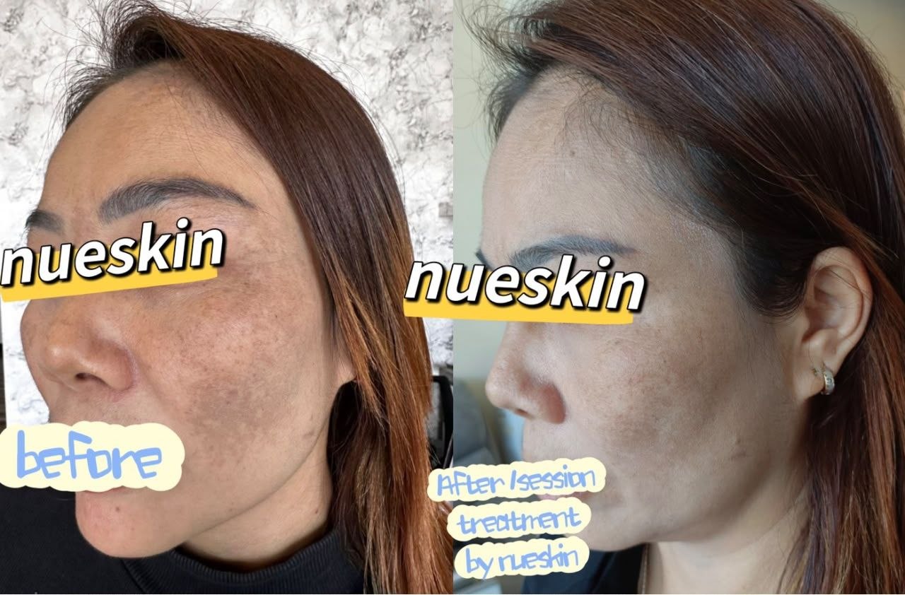 Skin brightening treatment for dull skin after one session — Nue Skin Beauty Esthetique