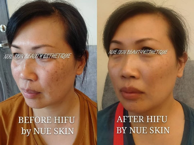 HIFU Lifting before and after — Nue Skin Beauty Esthetique