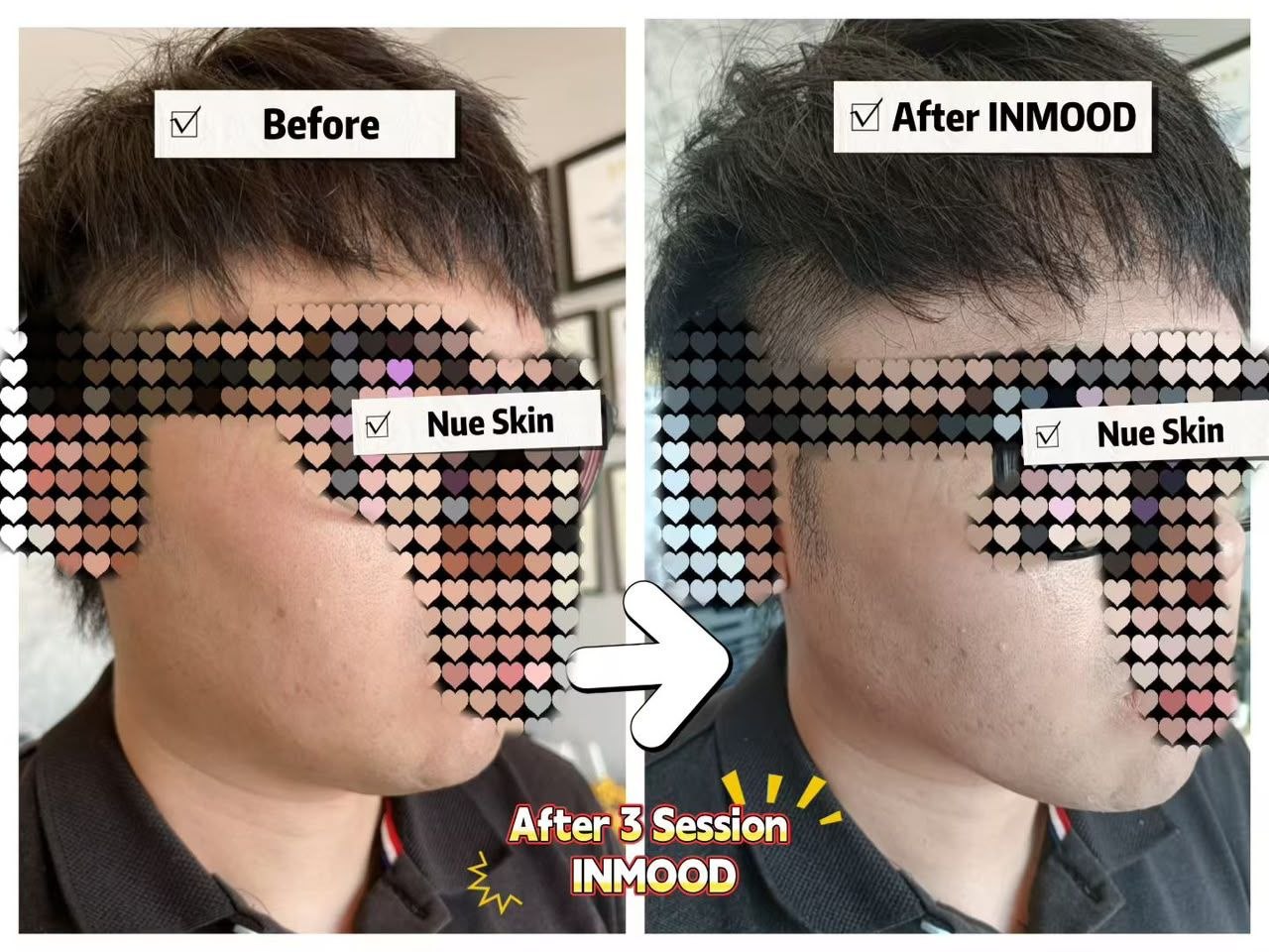 INMOOD Face Slimming before and after — Nue Skin Beauty Esthetique