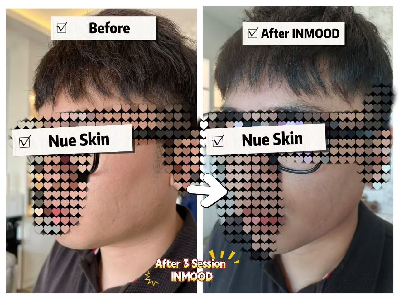 INMOOD Face Slimming before and after — Nue Skin Beauty Esthetique