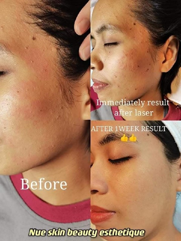 Laser Skin Treatment before and after — Nue Skin Beauty Esthetique