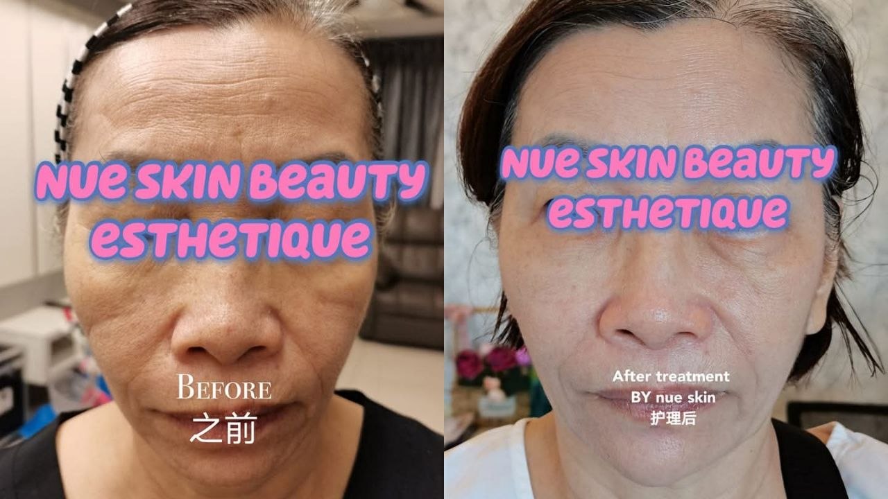 Skin Renewal Treatment before and after — Nue Skin Beauty Esthetique