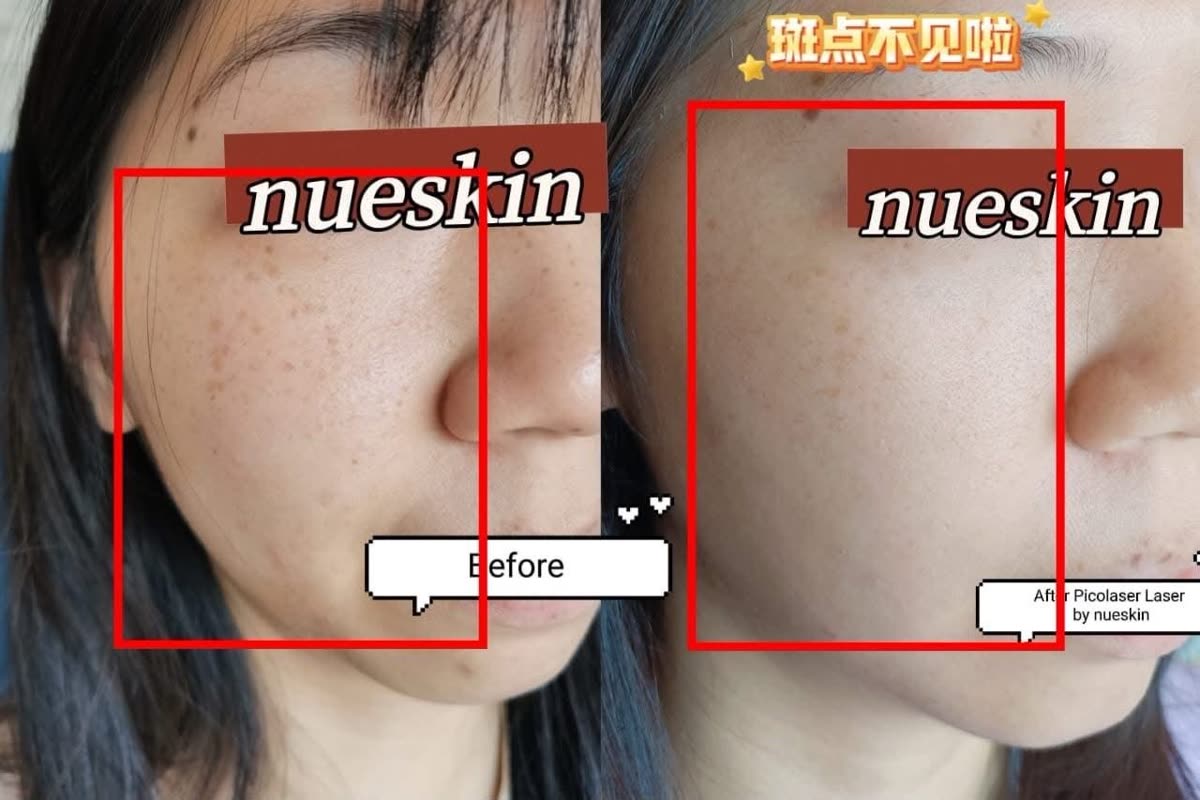 Client treatment result before and after — Nue Skin Beauty Esthetique