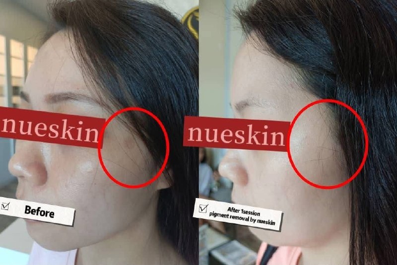 Client treatment result before and after — Nue Skin Beauty Esthetique