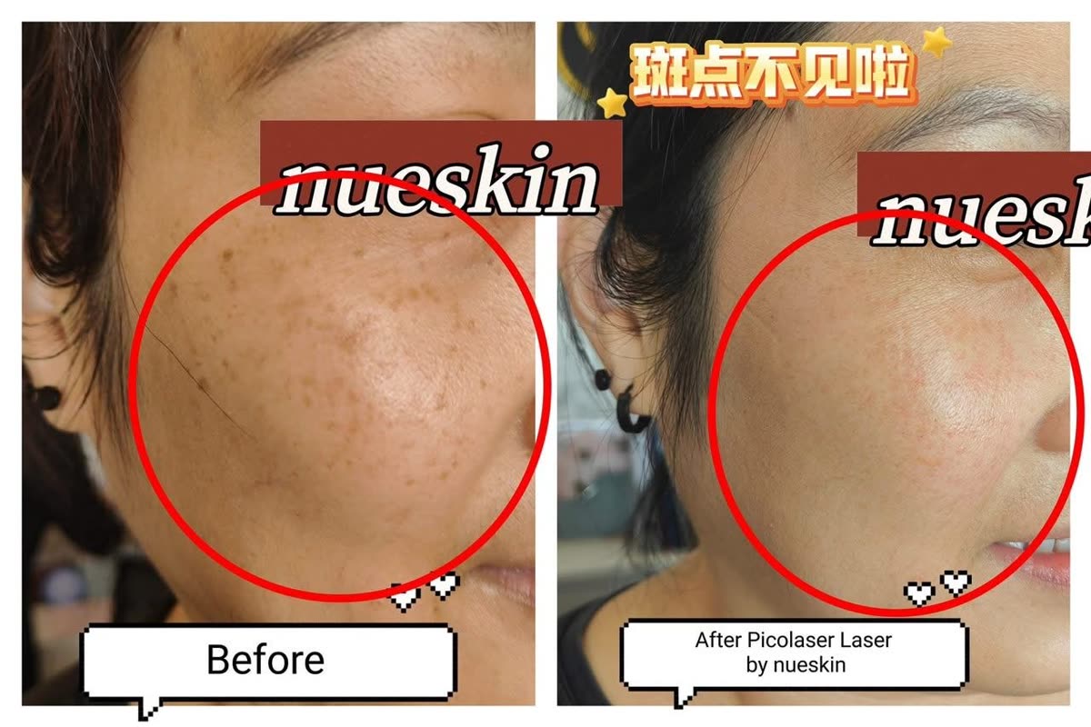 Client treatment result before and after — Nue Skin Beauty Esthetique