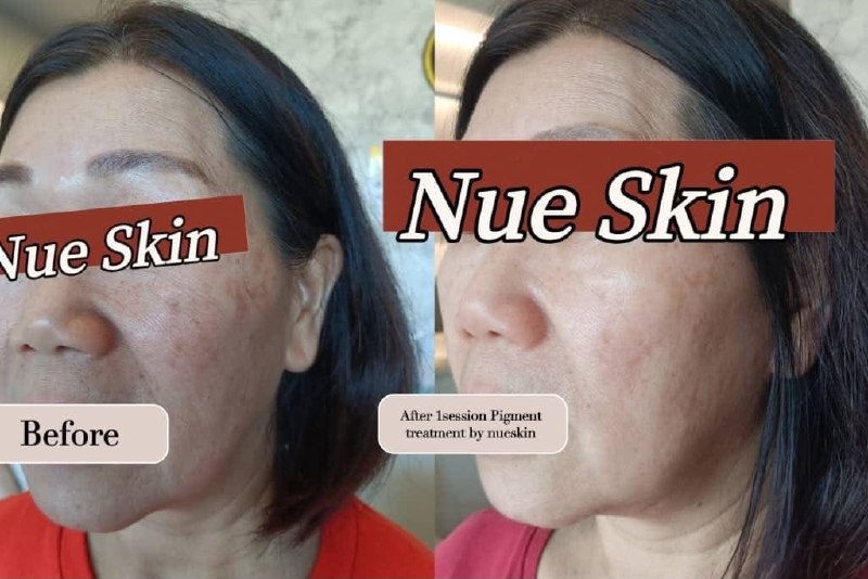 Client treatment result before and after — Nue Skin Beauty Esthetique