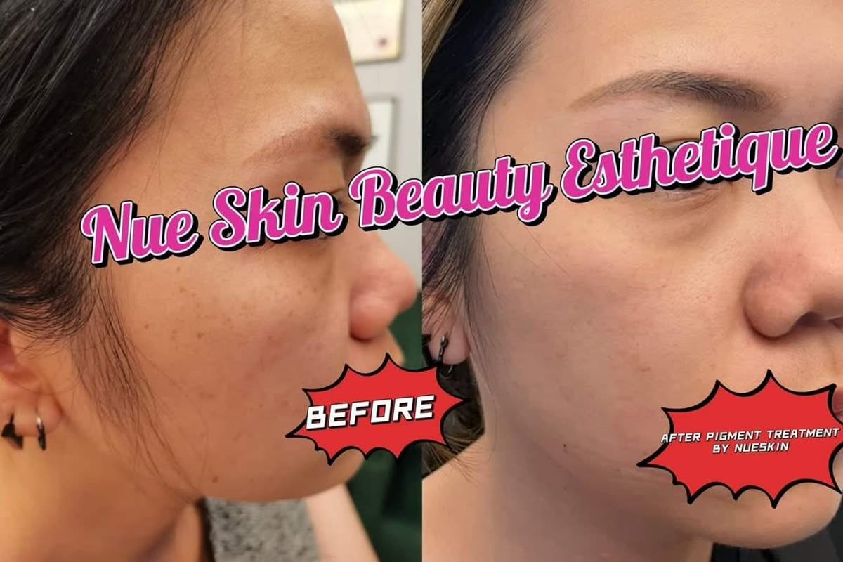 Client treatment result before and after — Nue Skin Beauty Esthetique