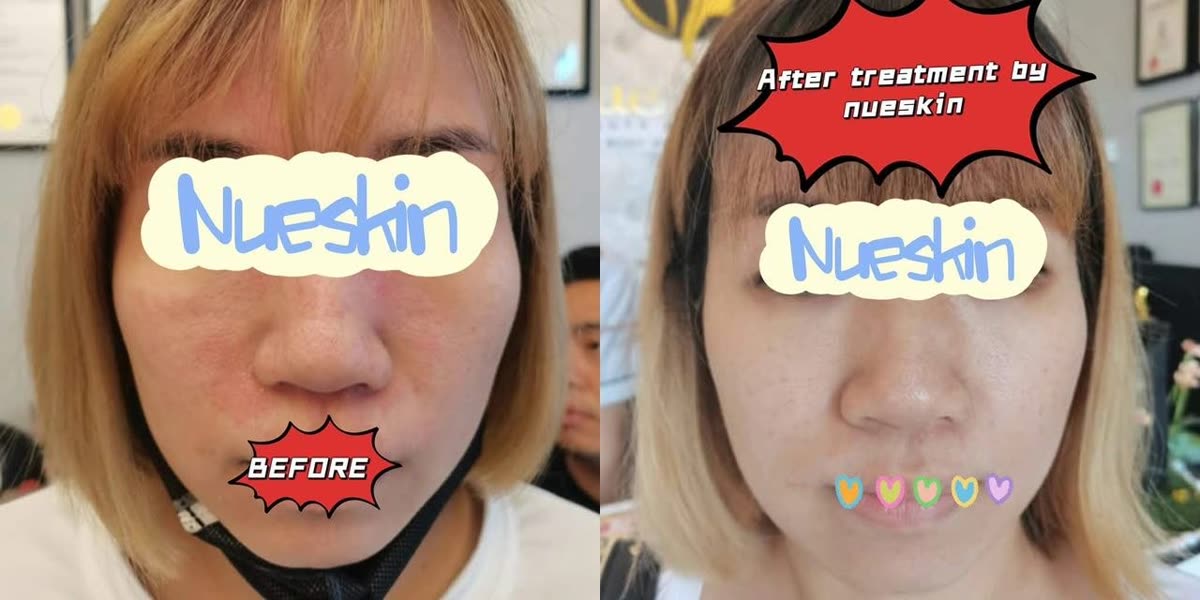 Client treatment result before and after — Nue Skin Beauty Esthetique