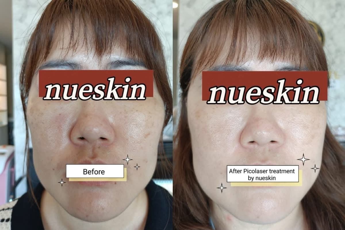 Client treatment result before and after — Nue Skin Beauty Esthetique