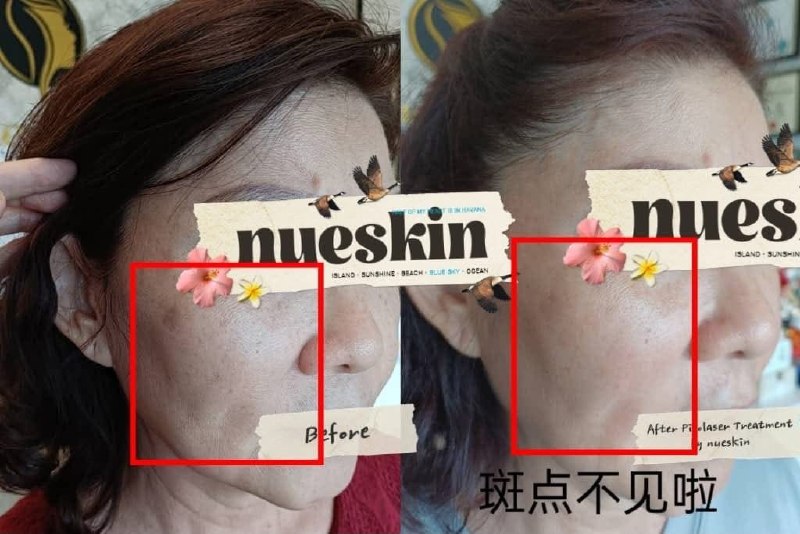 Client treatment result before and after — Nue Skin Beauty Esthetique
