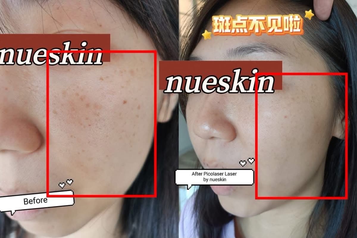 Client treatment result before and after — Nue Skin Beauty Esthetique
