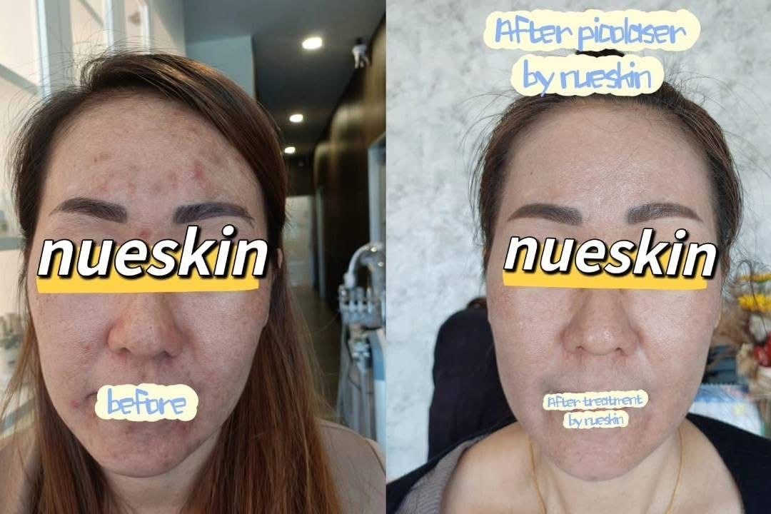 Client treatment result before and after — Nue Skin Beauty Esthetique