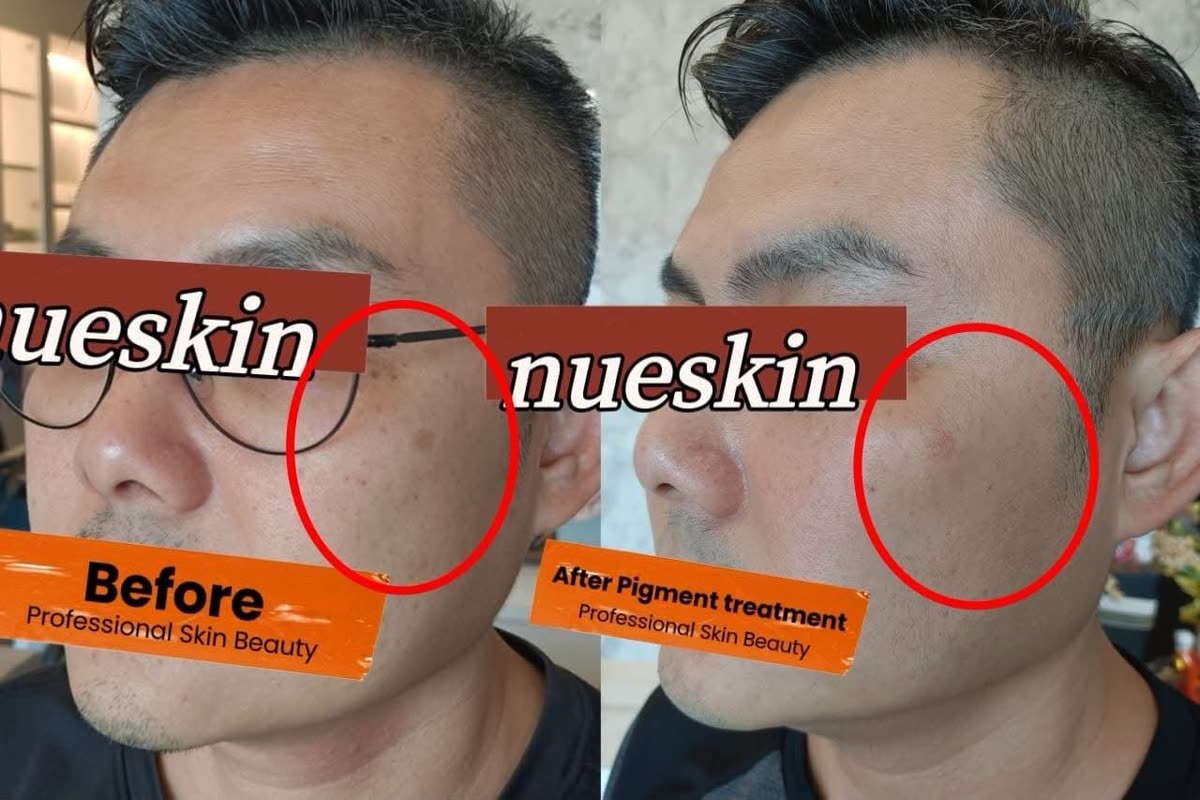 Client treatment result before and after — Nue Skin Beauty Esthetique