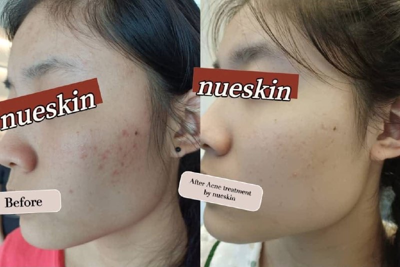 Client treatment result before and after — Nue Skin Beauty Esthetique