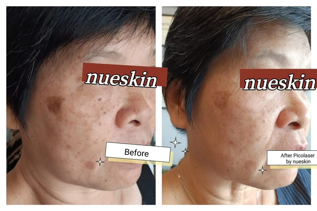 Client treatment result before and after — Nue Skin Beauty Esthetique